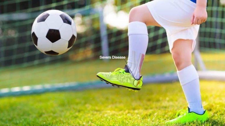 2023 Guide To The Best Cleats For Servers Disease: Keep Your Child Active & Injury-Free