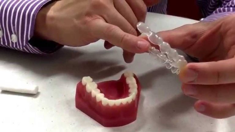 Discover The Best Dental Wax For Invisalign In 2023: Get A Perfect Smile Now!