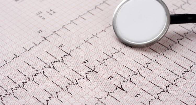2023’S Must-Have Ekg Book For Nurses: Get Ahead Of The Curve!