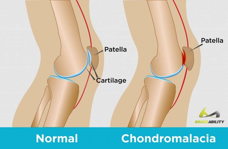 2023’S Best Knee Brace For Chondromalacia Patella: The Ultimate Guide