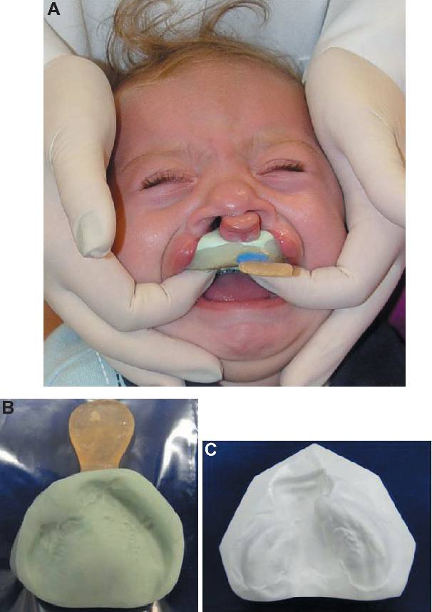 2023 Guide: Find The Best Pacifier For Cleft Lip & Make Feeding Easy!