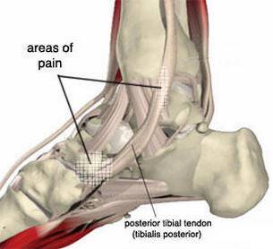 2023’S Best Walking Boot For Posterior Tibial Tendonitis: Find The Right Fit For You!