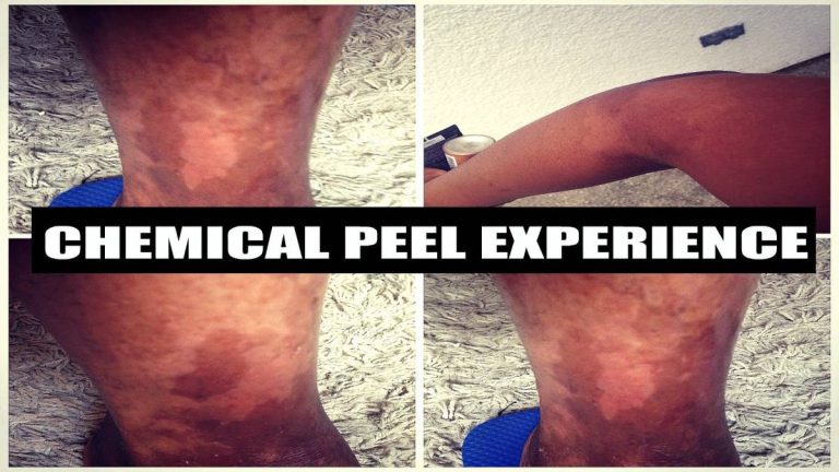 2023’S Best Chemical Peels To Smooth Your Inner Thighs – Revealed!