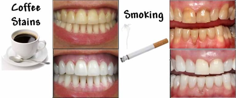 2023’S Top Teeth Whitening Solutions For Smokers: A Bright Smile Transformation!