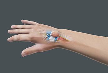 Say Goodbye To Ganglion Cysts With Our Top Wrist Wraps In 2023