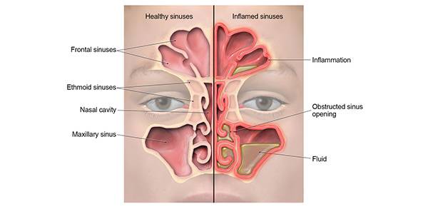 Discover The Ultimate Adult Sinus Infection Antibiotic For 2023: Unveiling The Top Choice!