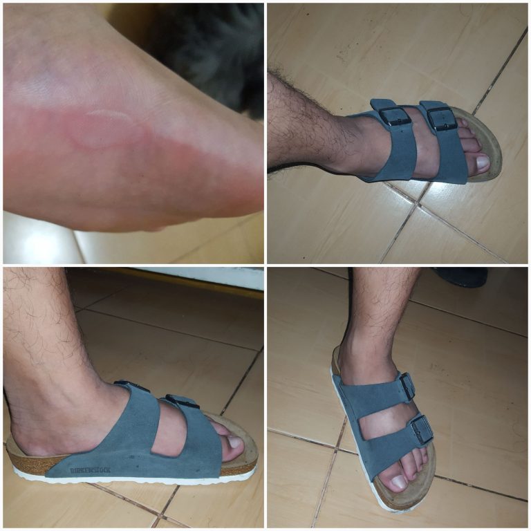 Birkenstock Blisters: Effective Tips To Prevent And Treat