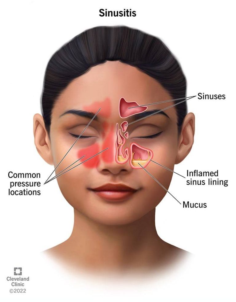 The Top Sinus Infection Medicines Of 2023: Effective Remedies For Fast Relief