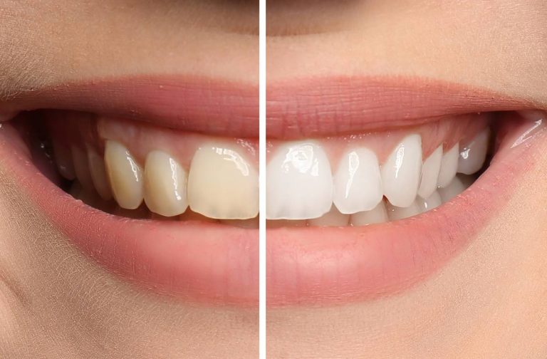 Get Dazzling White Teeth With The Best Gentle Teeth Whitening Solutions In 2023!